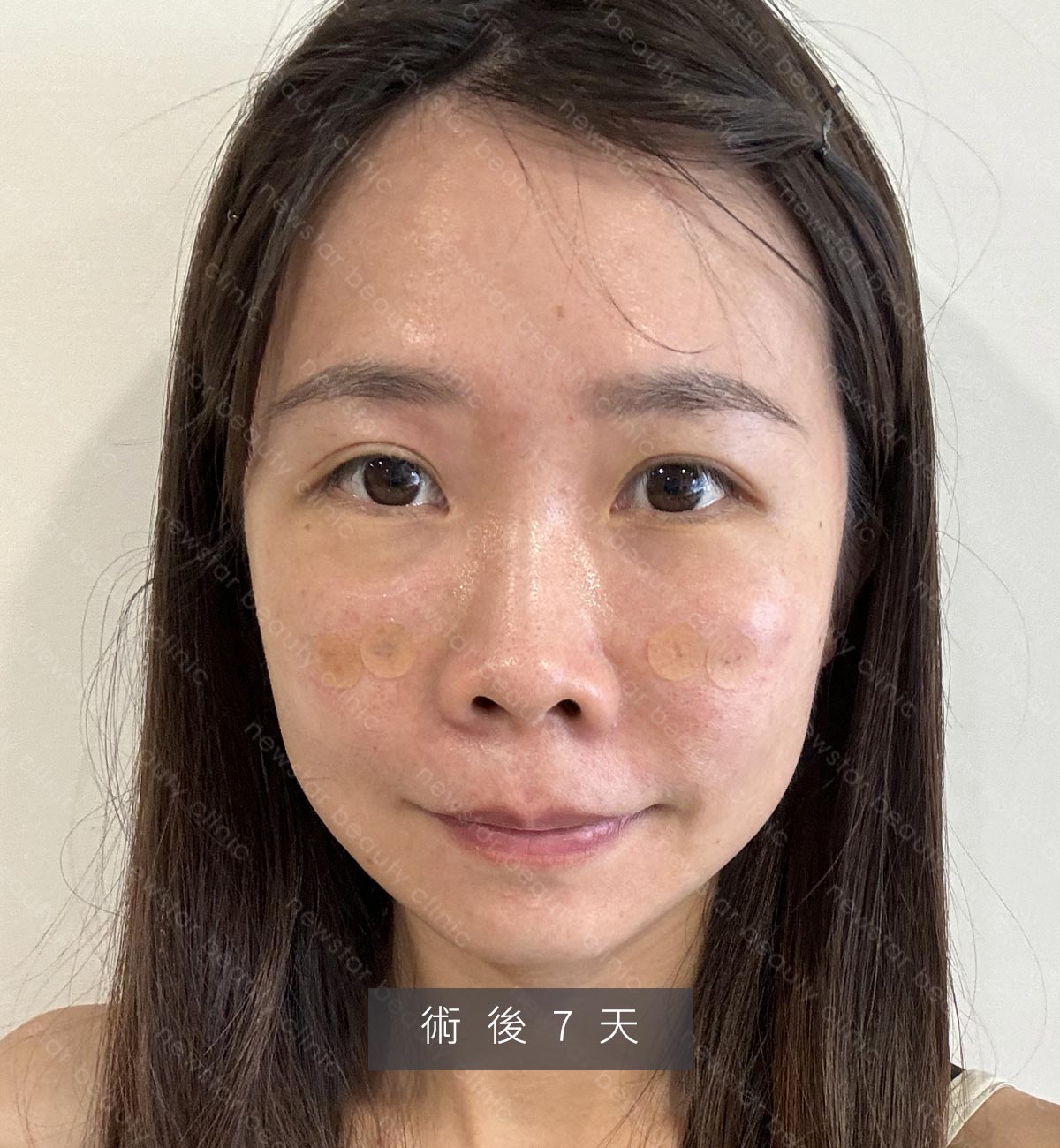 眼袋手術_術後恢復7天