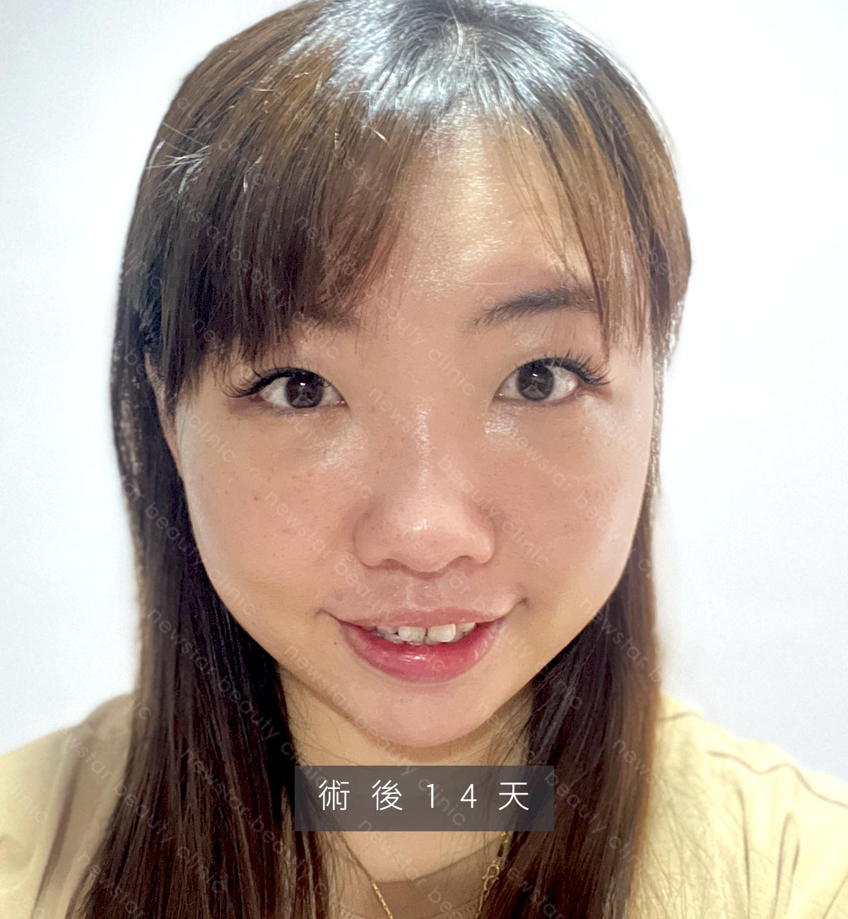 眼袋手術_貝貝_生活照_術後14天