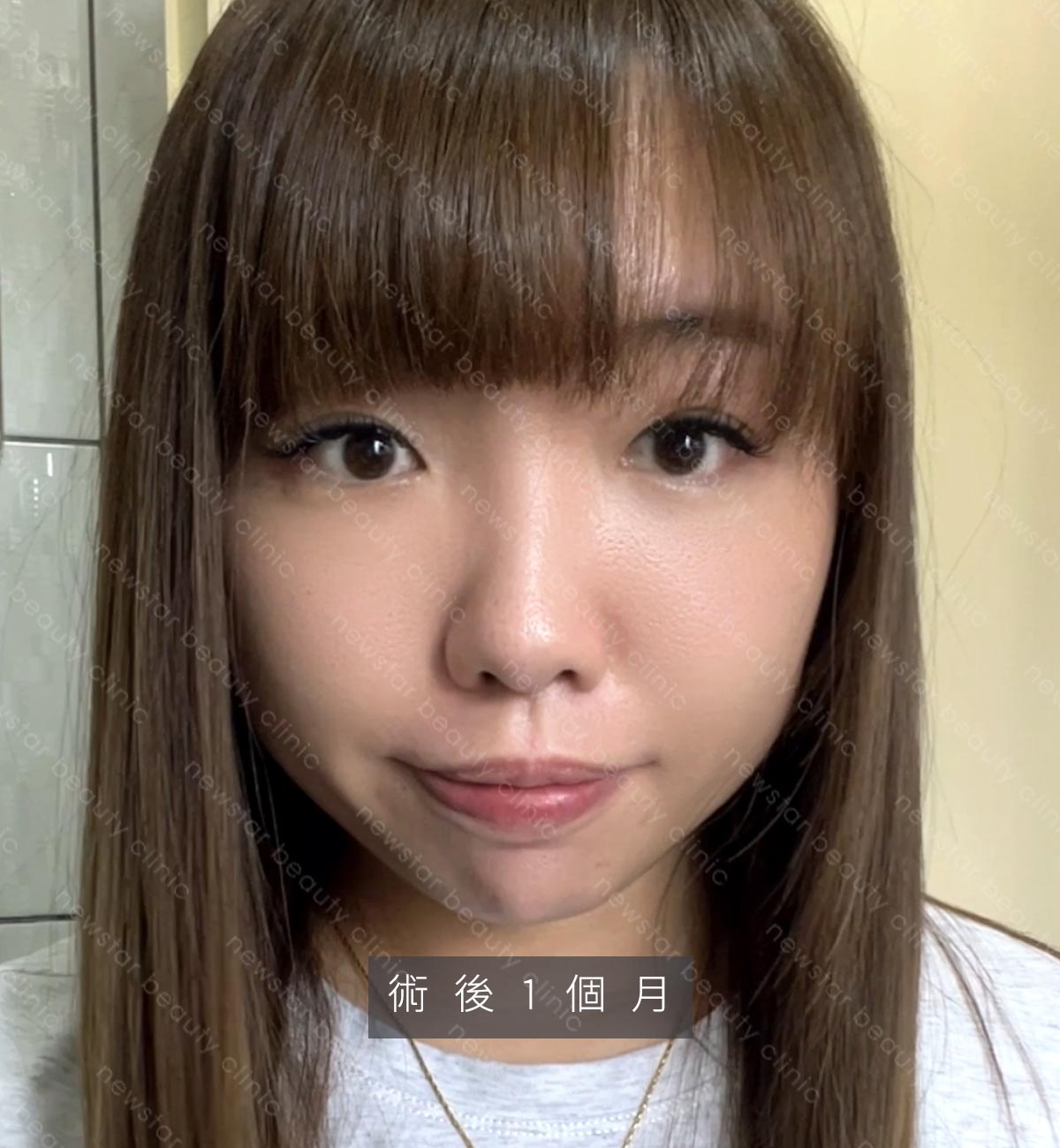 眼袋手術_貝貝_生活照_術後1個月jpg