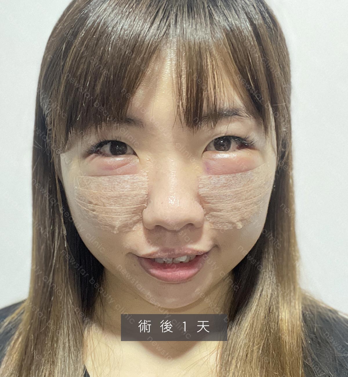 眼袋手術_貝貝_生活照_術後1天