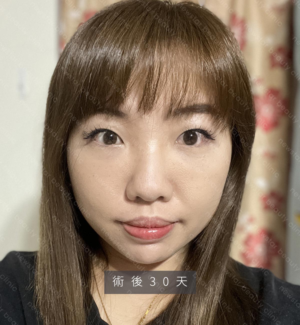 眼袋手術_貝貝_生活照_術後30天