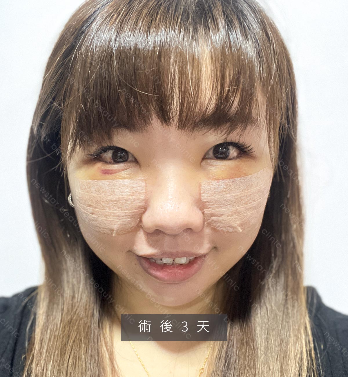 眼袋手術_貝貝_生活照_術後3天