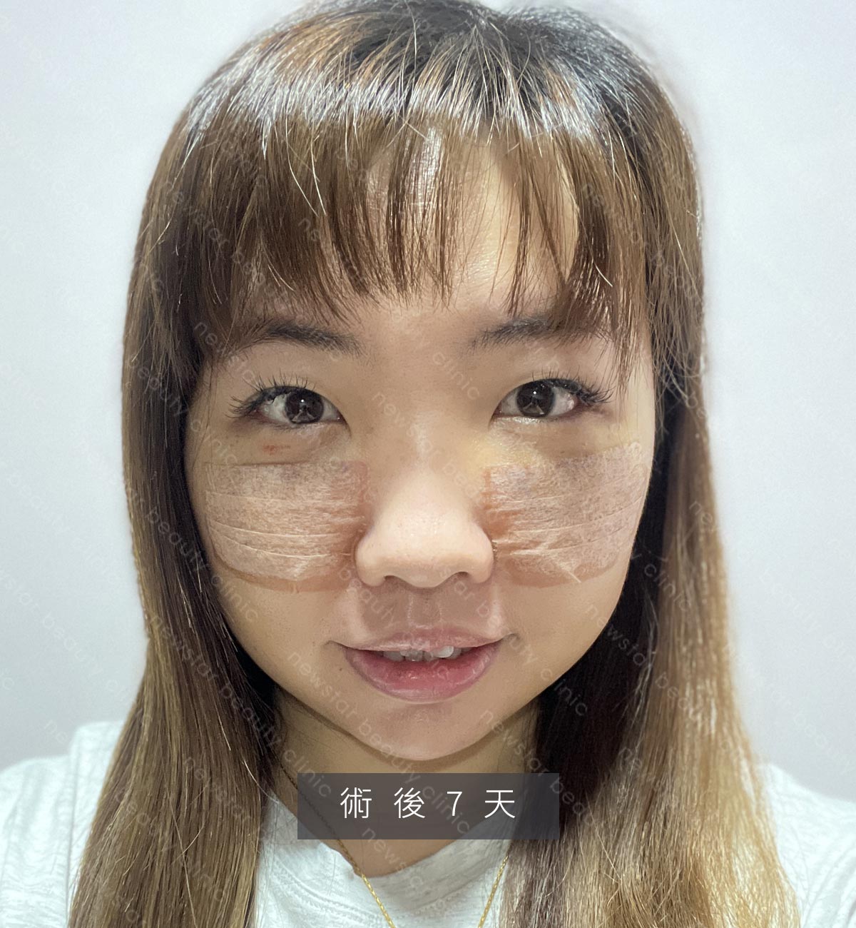 眼袋手術_貝貝_生活照_術後7天