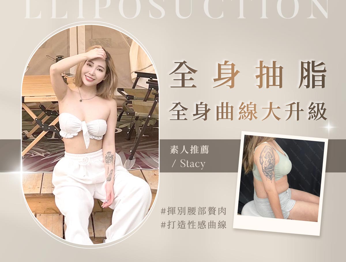 手術官網案例_外bn_全身抽脂