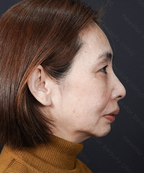 養育髮治療_案例