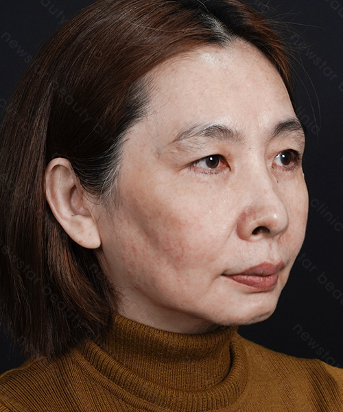 養育髮治療_案例