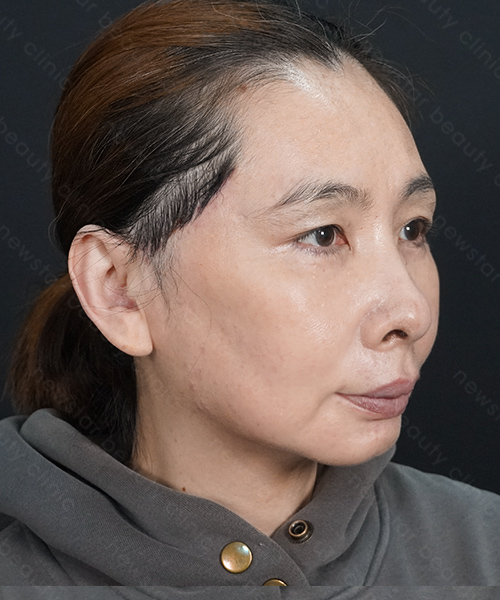 養育髮治療_案例