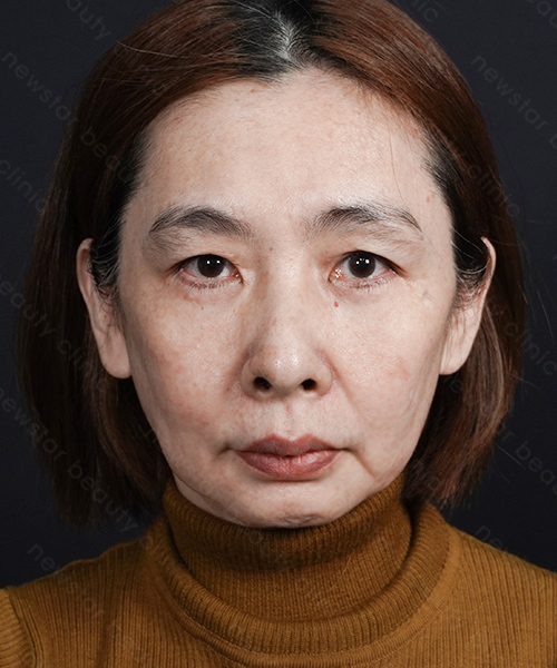 養育髮治療_PRP案例