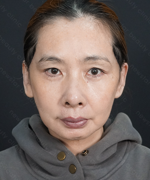 養育髮治療_PRP案例