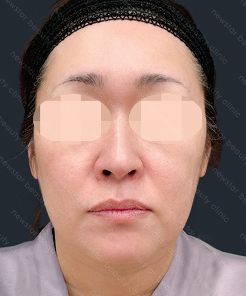 養育髮治療_PRP案例