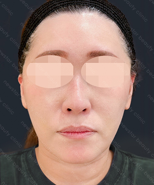 養育髮治療_PRP案例