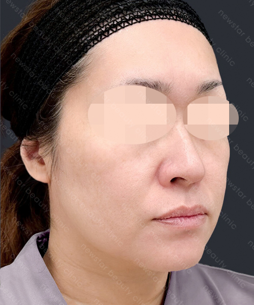 養育髮治療_PRP案例