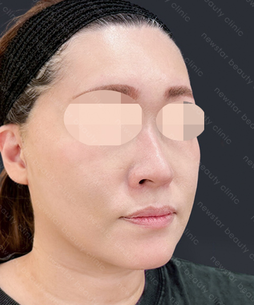 養育髮治療_PRP案例