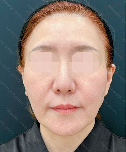 養育髮治療_PRP案例