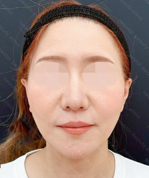 養育髮治療_PRP案例