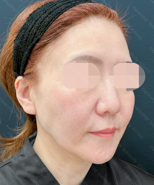 養育髮治療_PRP案例