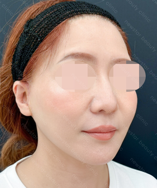 養育髮治療_PRP案例