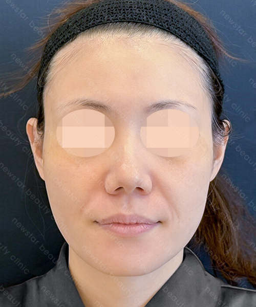 養育髮治療_PRP案例