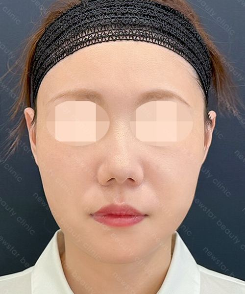 養育髮治療_PRP案例